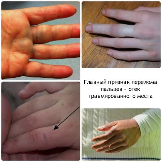 Отекло Отек