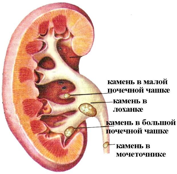 Болезнь Мочекаменная болезнь