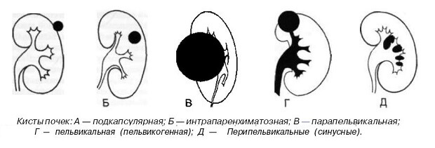 Киста Появилась киста