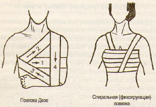 Поменять Перевязка дезо