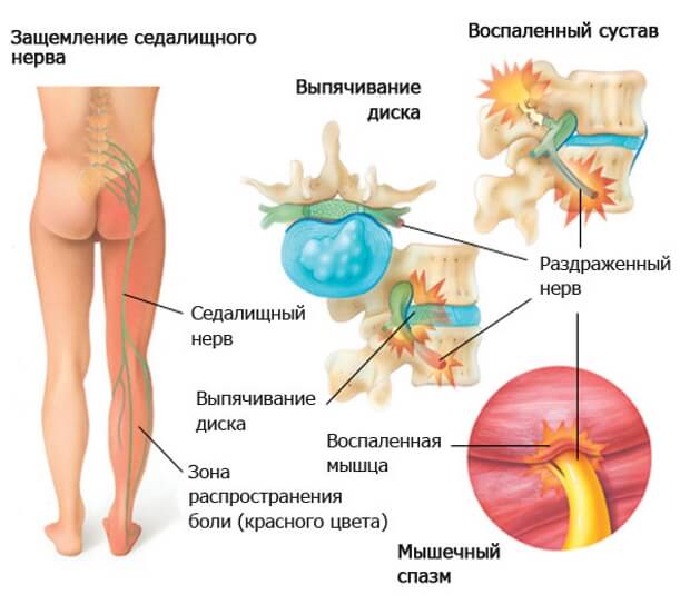 Защемление Защемление седалищного нерва