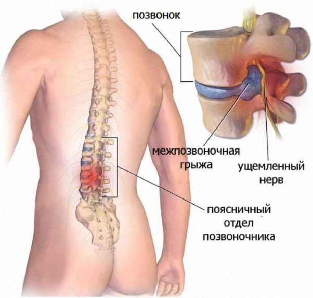 Грыжа Межпозвоночная грыжа