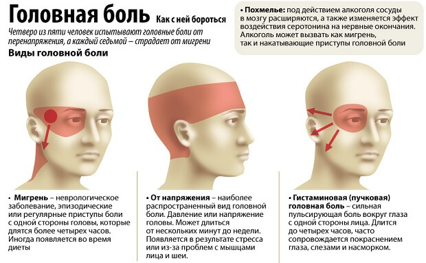 Мигрень От напряжения