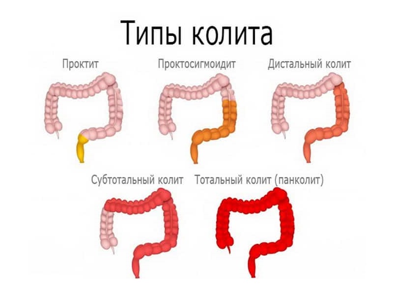 Разновидности колита Виды колита