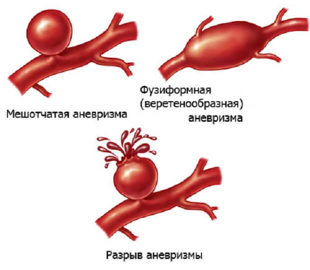 Заболевание Аневризма