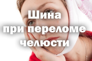 Шина при сломанной челюсти Шина при переломе челюсти