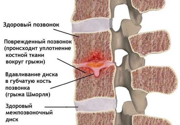 Здоровый позвонок Поврежденный позвонок