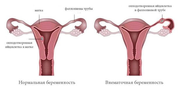 Причина Внематочная беременность