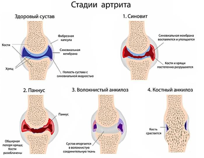 Стадии артрита Этапы артрита