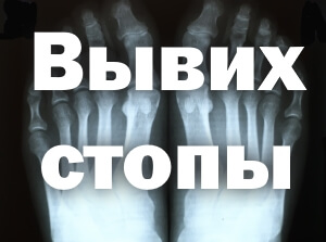 Лечение вывиха стопы Вывих стопы