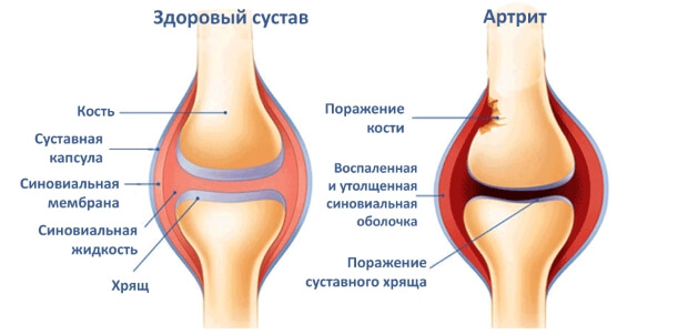 Болезнь Артрит