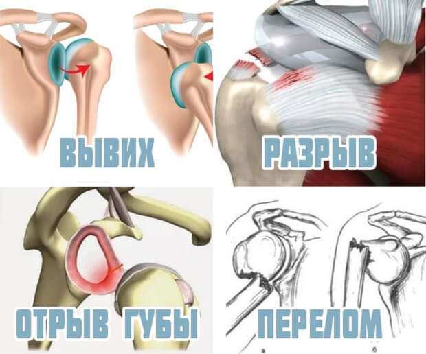 Травмирование Повреждение