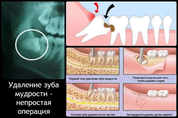 Зубик Мудрости