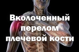 Вколоченный перелом плеча Вколоченный перелом плечевой кости