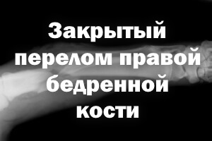 Закрытый перелом правого бедра Закрытый перелом правой бедренной кости